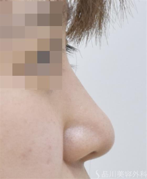 症例NO.50692のAFTER写真