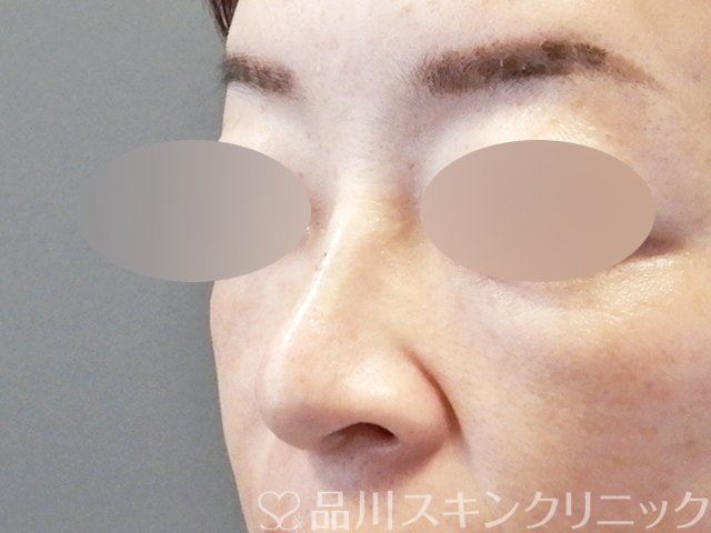 症例NO.66774のAFTER写真
