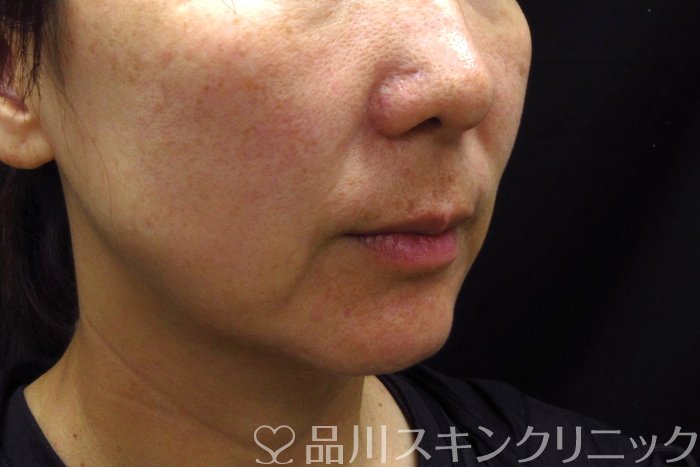 症例NO.74332のBEFORE写真