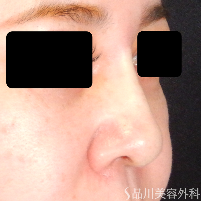 症例NO.69310のAFTER写真