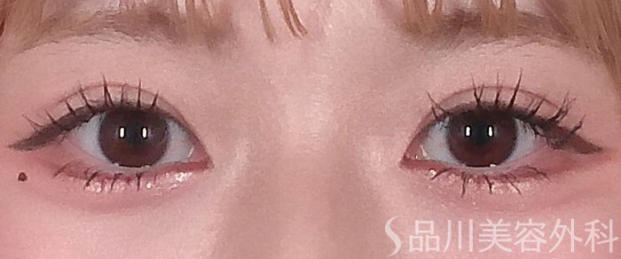 症例NO.69236のAFTER写真