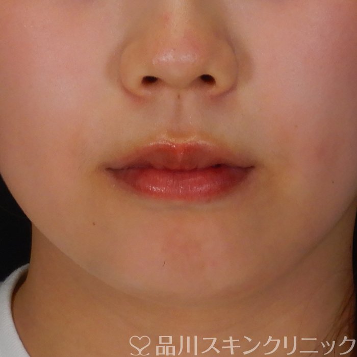 症例NO.69764のBEFORE写真