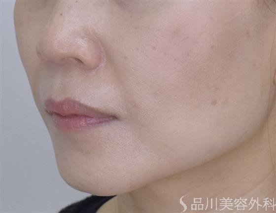 症例NO.51125のAFTER写真