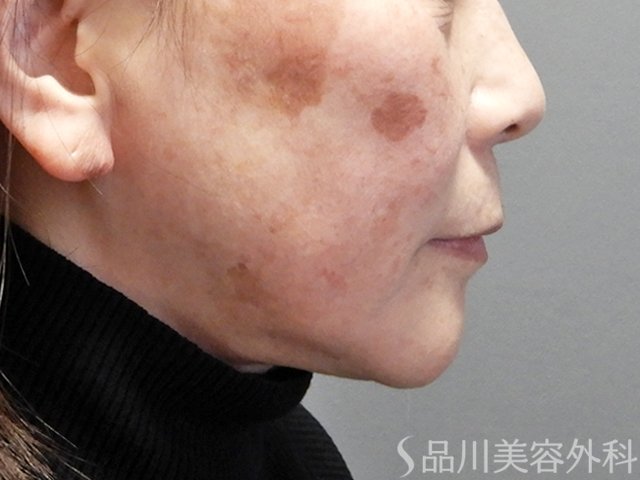 症例NO.70431のBEFORE写真
