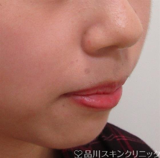症例NO.30724のBEFORE写真