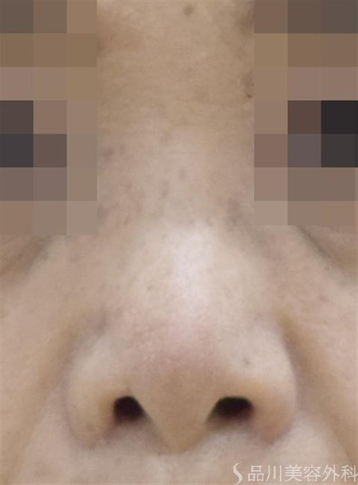 症例NO.48901のAFTER写真