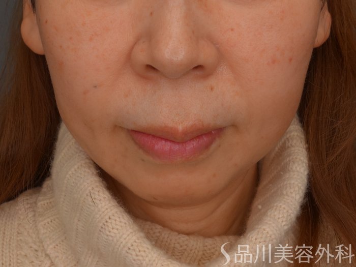 症例NO.65592のBEFORE写真