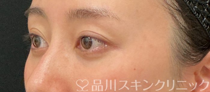 症例NO.74931のBEFORE写真