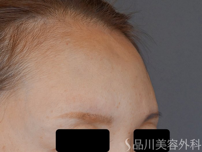 症例NO.72105のAFTER写真