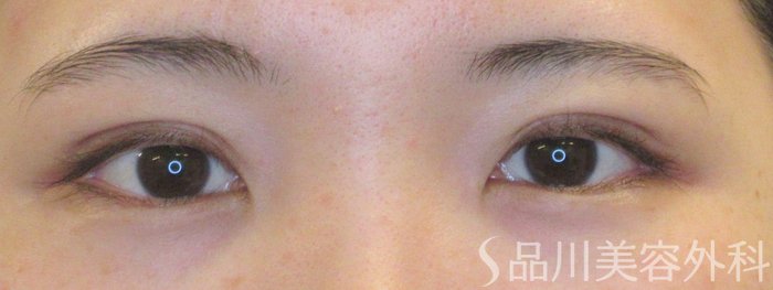 症例NO.69490のAFTER写真