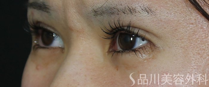 症例NO.72114のAFTER写真