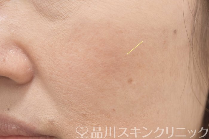 症例NO.70545のAFTER写真