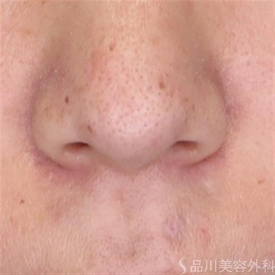 症例NO.55022のAFTER写真