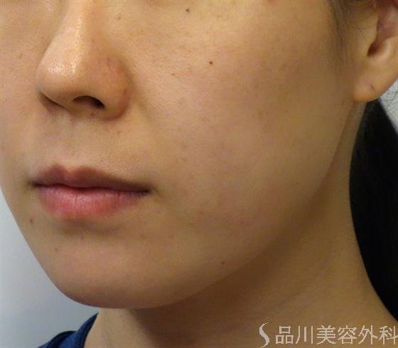 症例NO.47416のBEFORE写真