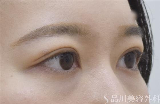 症例NO.54042のAFTER写真