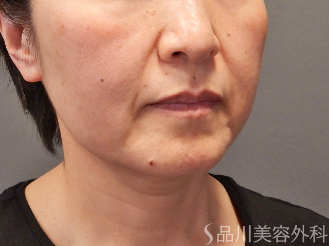 症例NO.74390のBEFORE写真