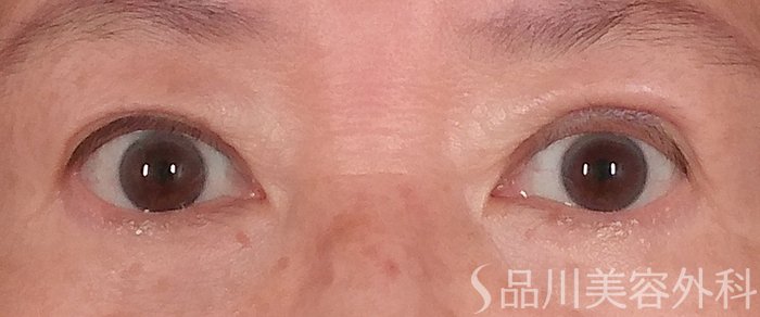 症例NO.71179のAFTER写真