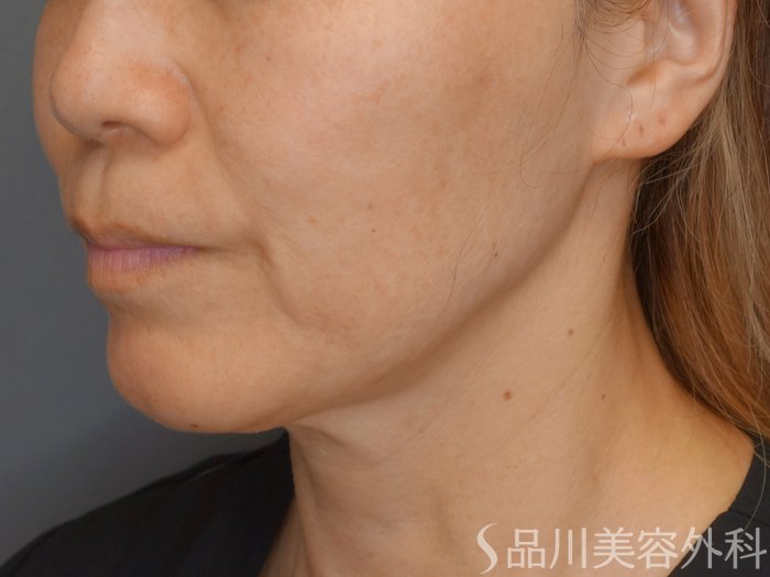 症例NO.71072のBEFORE写真
