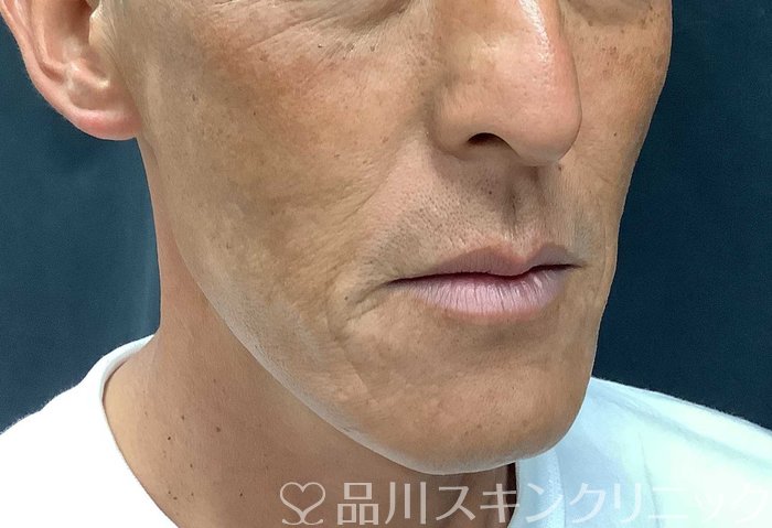 症例NO.71042のAFTER写真
