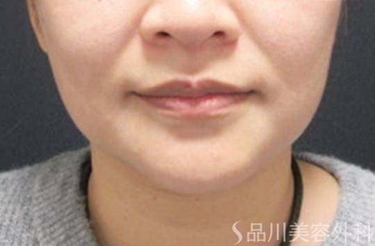 症例NO.72724のBEFORE写真