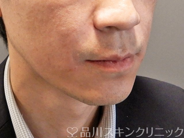 症例NO.68334のAFTER写真