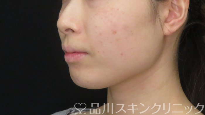 症例NO.72287のBEFORE写真