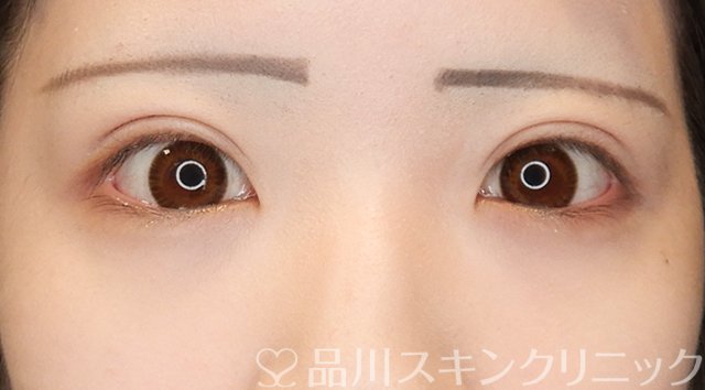 症例NO.66011のAFTER写真
