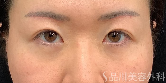 症例NO.71247のAFTER写真