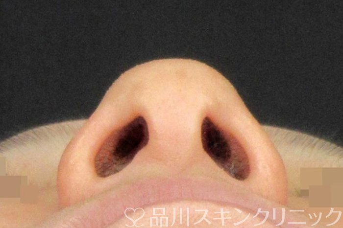 症例NO.62303のBEFORE写真