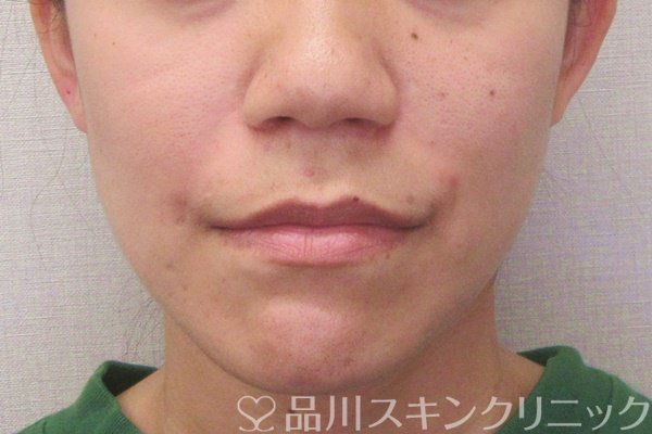 症例NO.70203のAFTER写真