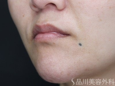 症例NO.69819のBEFORE写真