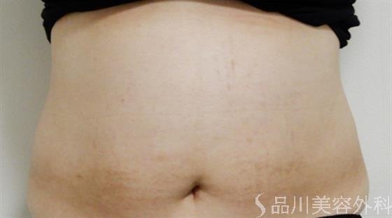 症例NO.38510のAFTER写真