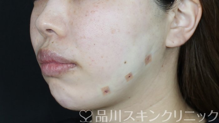 症例NO.71269のAFTER写真