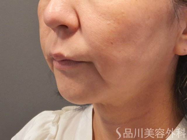 症例NO.72789のBEFORE写真