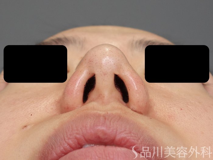 症例NO.72263のAFTER写真