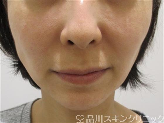 症例NO.34169のBEFORE写真
