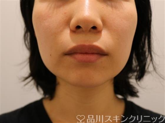 症例NO.45746のBEFORE写真