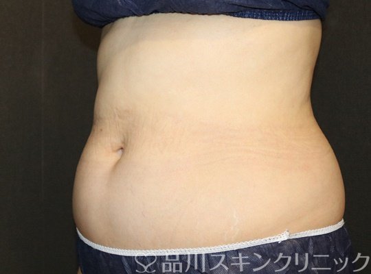 症例NO.75239のAFTER写真