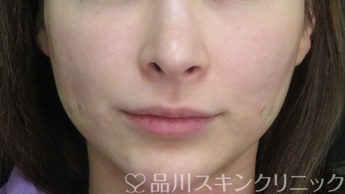 症例NO.71198のAFTER写真