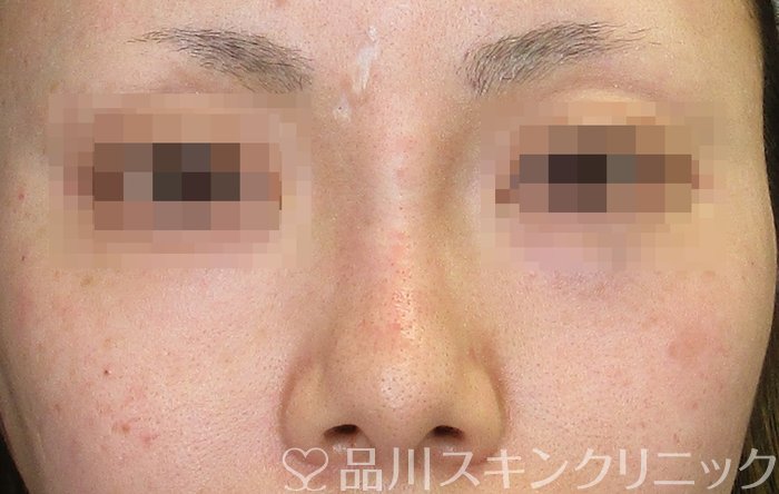 症例NO.73064のAFTER写真