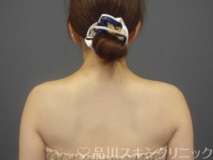 症例NO.74210のAFTER写真