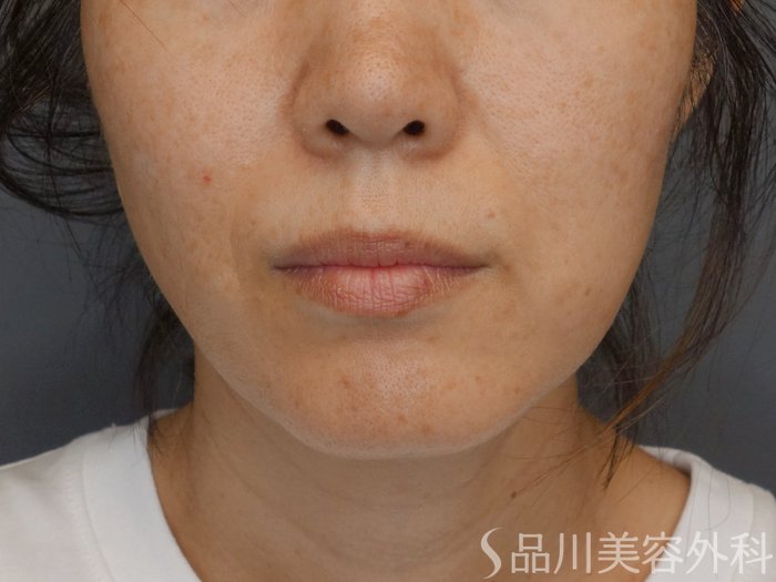 症例NO.71704のBEFORE写真