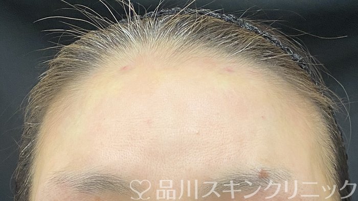症例NO.74874のAFTER写真
