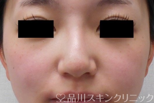 症例NO.69564のBEFORE写真