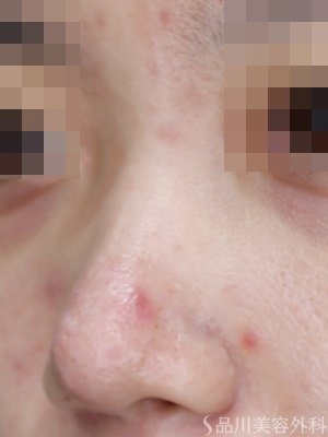 症例NO.71639のBEFORE写真