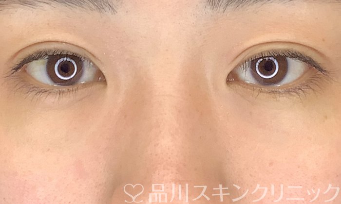 症例NO.65301のBEFORE写真