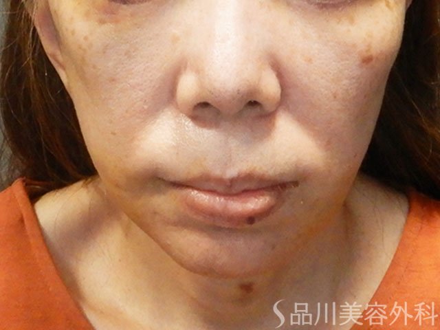 症例NO.72187のAFTER写真