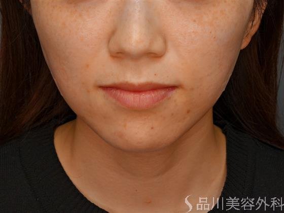 症例NO.58145のAFTER写真