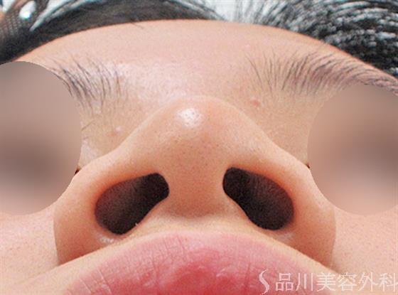 症例NO.22692のBEFORE写真