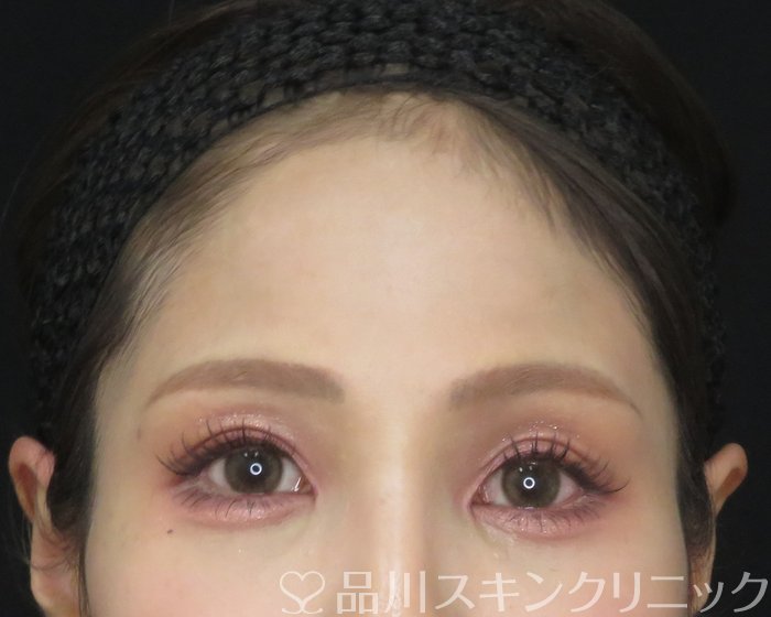 症例NO.62330のBEFORE写真